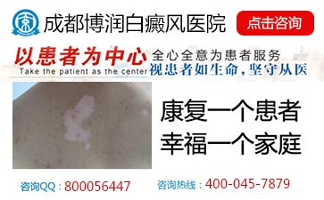 老年白癜风的症状