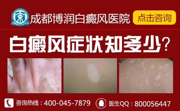 儿童白癜风能治疗好吗