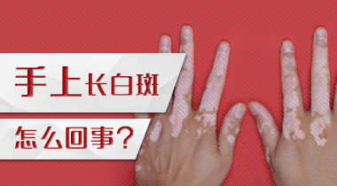 四川省成都医院可以治疗白斑吗？如何治疗能够使手部的白癜风消失？